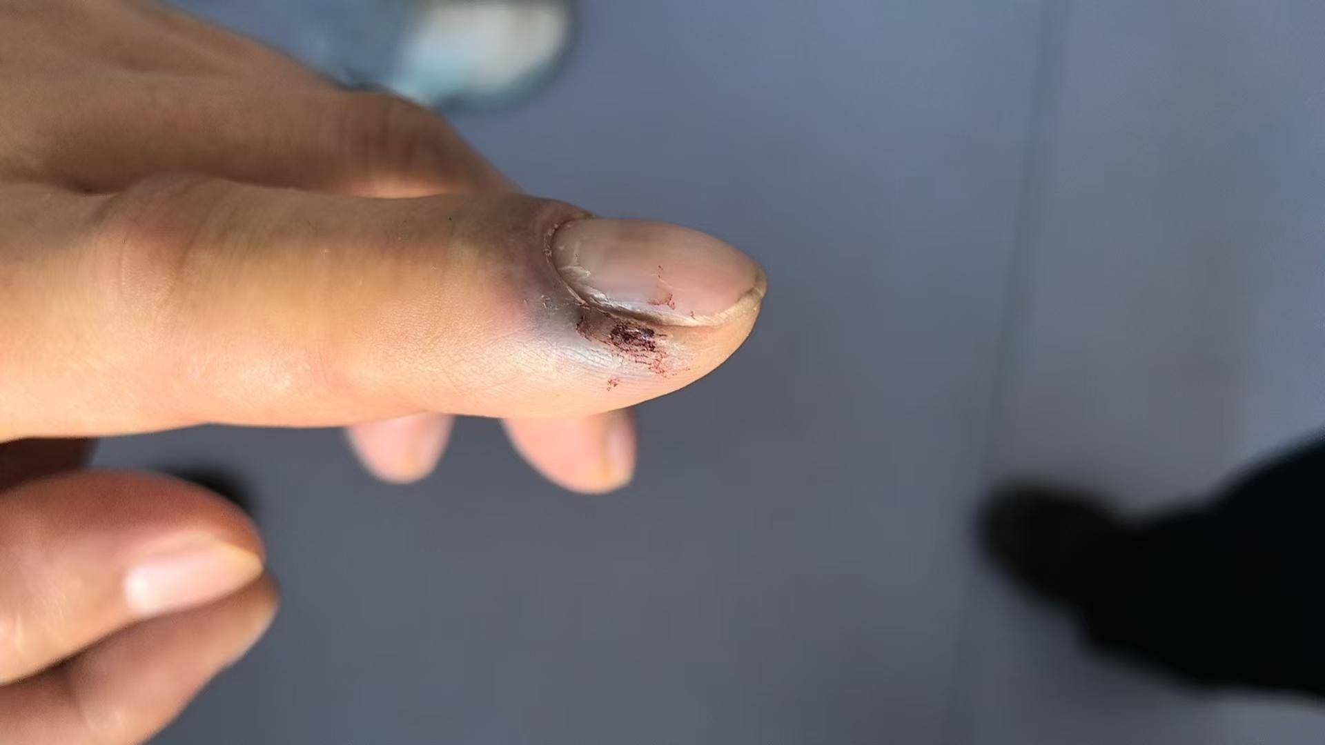 皇冠信用網怎么租_青海一男子被罕见剧毒阿拉善蝮蛇咬伤皇冠信用網怎么租,因无血清一度想放弃治疗 警车开道转运700公里救命