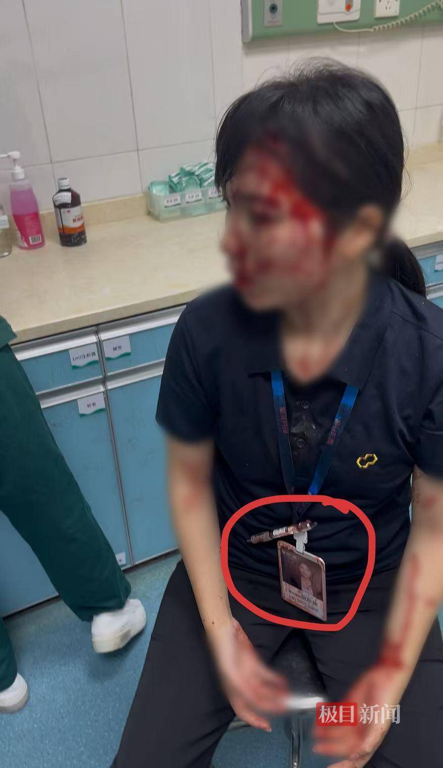 皇家苏斯达B队vs加的斯_“男子持水杯砸伤女同事被刑拘”后续:脸部缝20多针的女子已出院皇家苏斯达B队vs加的斯,否认抢单惹祸