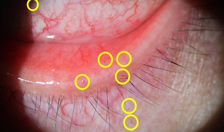 皇冠信用網开户_剧痛!一阵风吹过皇冠信用網开户,女子眼睛被扎进7根“黑刺”……近期多人中招
